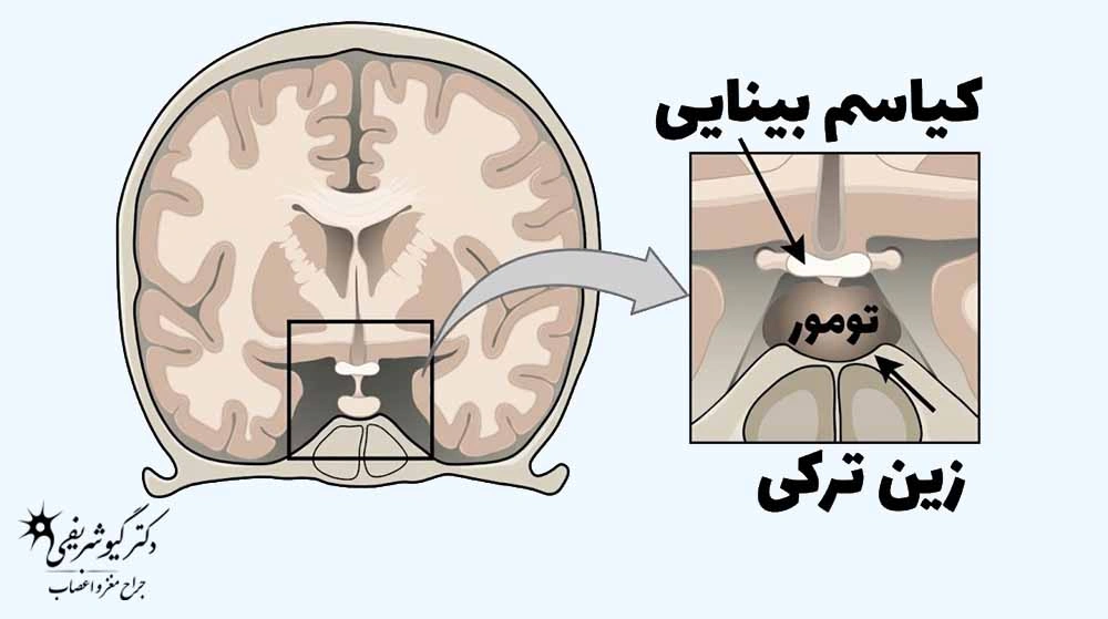 تومور هیپوفیز