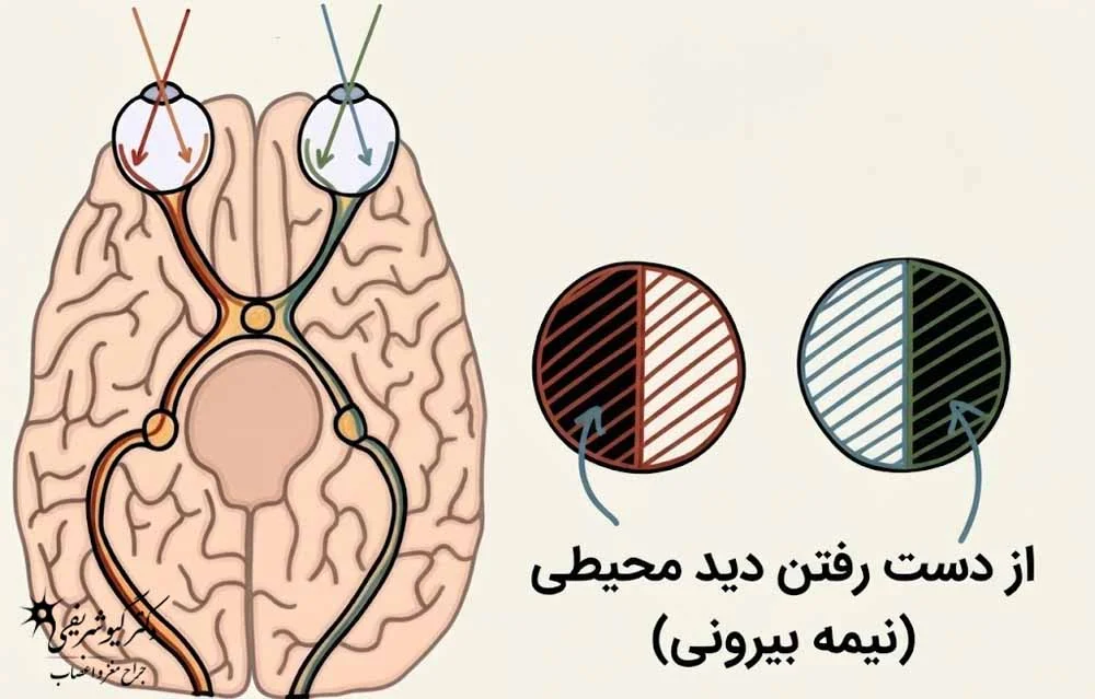کاهش دید