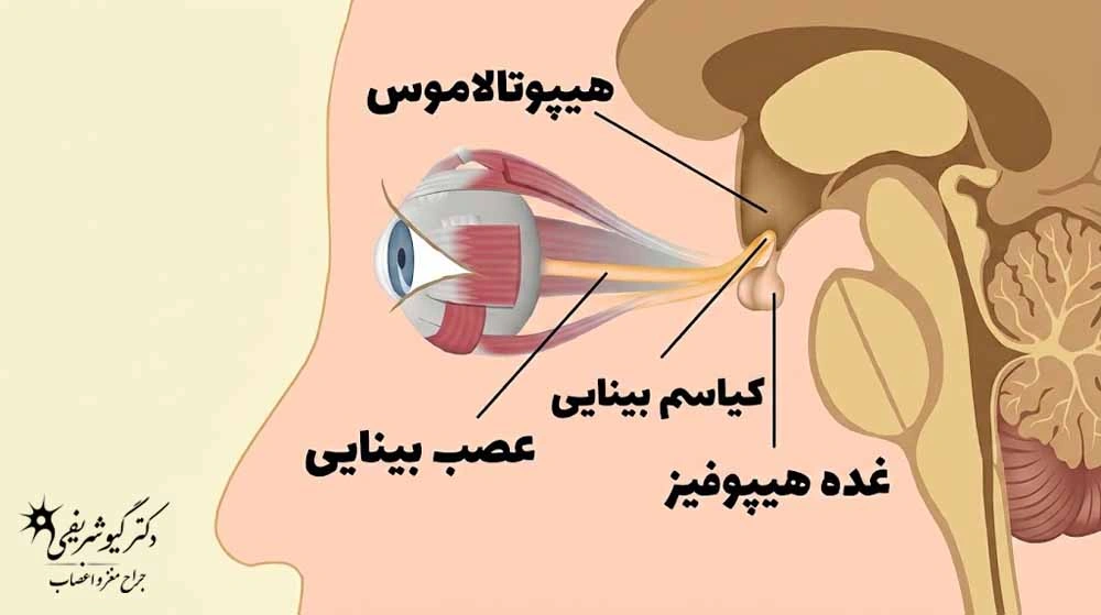 راهنمای کامل سؤالات متداول بیماران قبل از جراحی تومور هیپوفیز 3 فشار تومور
