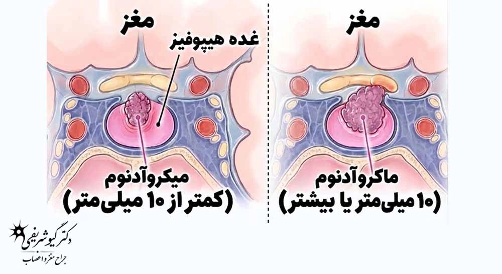 اندازه تومور