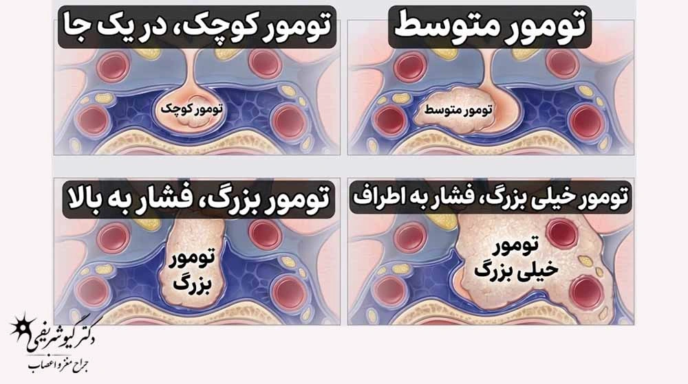 ناحیه انتشار تومور