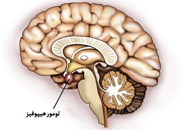 آدنوم هیپوفیز تومور پرولاکتینوما