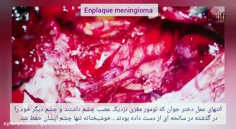 عمل دختر جوان که تومور مننژیوم مغزی نزدیک عصب چشم داشتند