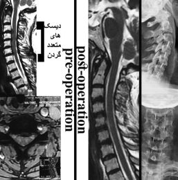 جراحی دیسک های متعدد گردن