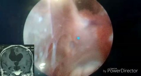 Endoscopic surgery of third ventricle