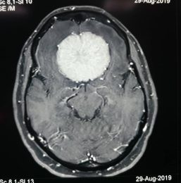 تومور بزرگ مننژیوم