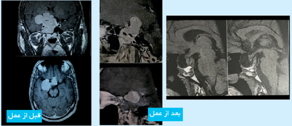 Pituitary-tumor-1