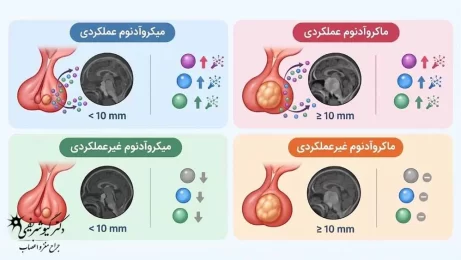 تومور هیپوفیز