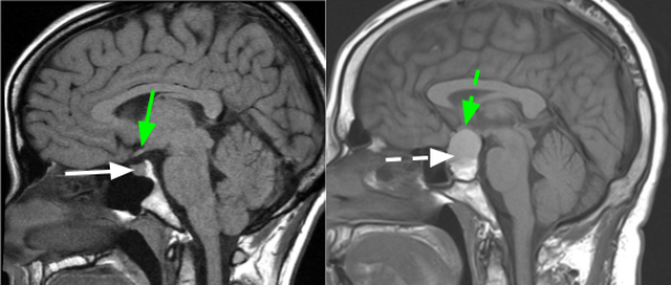 PituitaryTumor2