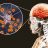 Meningoencephalitis