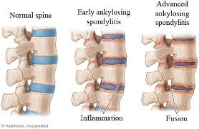 Spndylitis