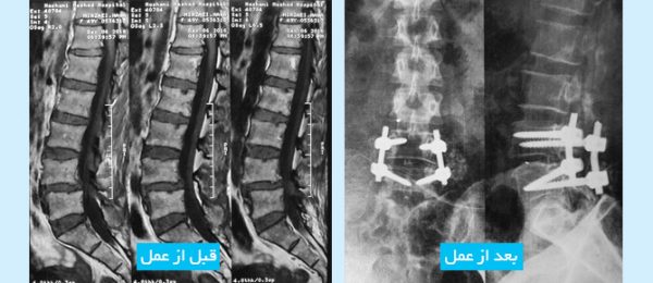 Spondylolisthesis-FA