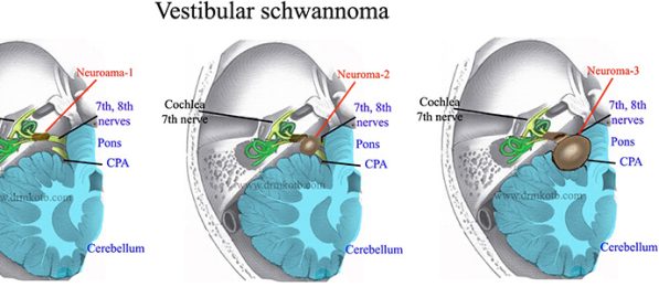 Vestibular-Schwannoma
