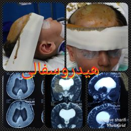 بزرگی جمجمه در اطفال به دنبال هیدروسفالی