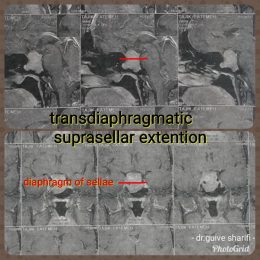 آدنوم هیپوفیز