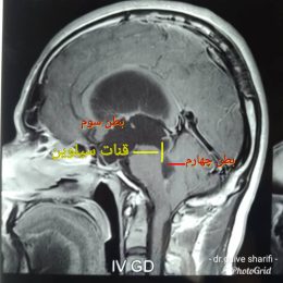 عمل آندوسکوپی و یا بسته مغز به دنبال هیدروسفالی