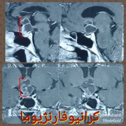 عمل تومور مغز از راه بینی و با آندوسکوپی