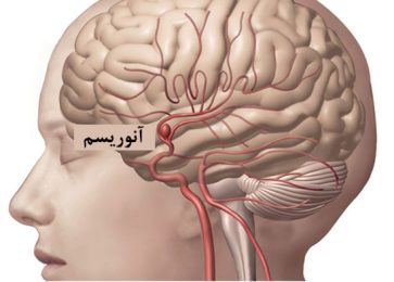 علل بروز خونریزی زیر عنکبوتیه