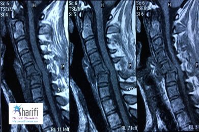 before-cervical-trauma-surgery-1