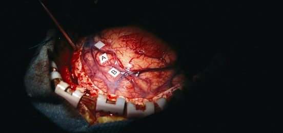 benign-brain-tumor