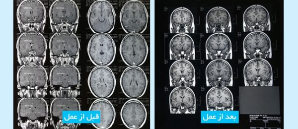 big-macro-adenoma-fa