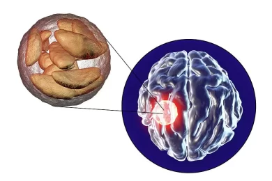 brain-abscess-caused-by-toxoplasma-gondii-kateryna-konscience-photo-library