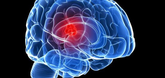 brain-cancer-1