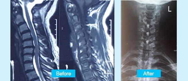 cervical-surgery-en