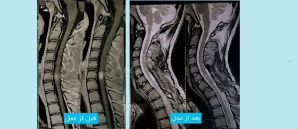 cord-tumor0-e1507383632764