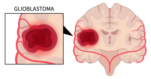 glioblastoma