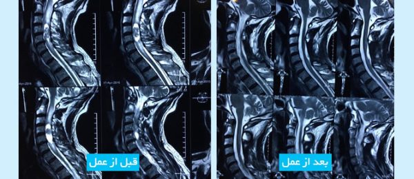 intramedullary-spinal-cord-tumor-fa