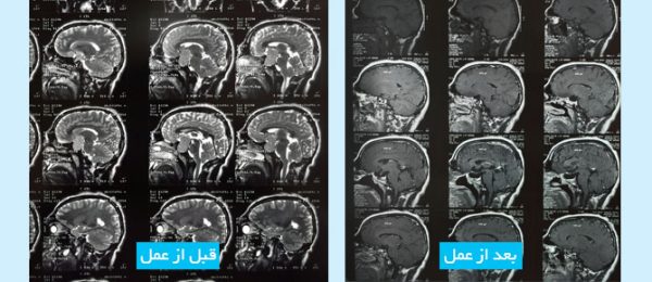 large-non-functional-pituitary-tumors