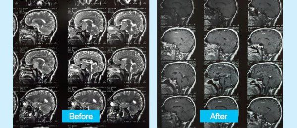 large-non-functional-pituitary-tumors-surgery-5