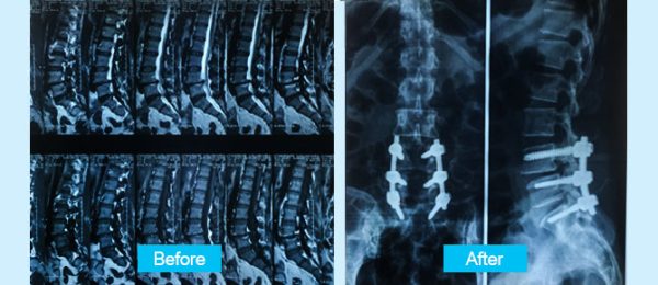 lumbar-disc-en-1