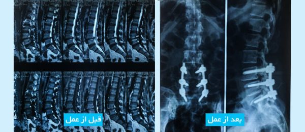 lumbar-disc-fa-1