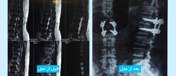 lumbar-disc-fa
