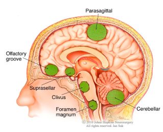 meningioma-ian-suk