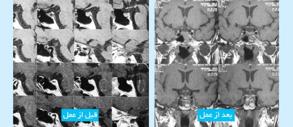 microadenoma-pituitary-tumor-FA