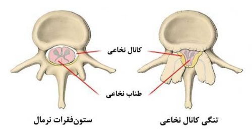 درمان گیاهی تنگی کانال نخاعی
