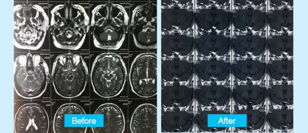 non-fuctional-pituitary-tumor-en