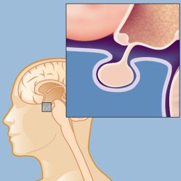 pituitary adenoma