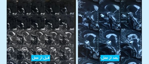 pituitary-tumor-fa-1