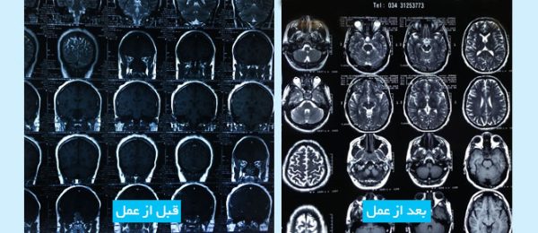 pituitary-tumor-fa