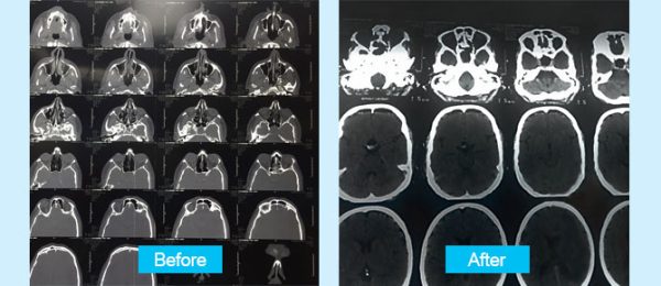 pituitary-tumor-surgery-through-the-nose