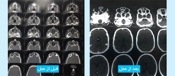 pituitary-tumor-surgery-through-the-nose1