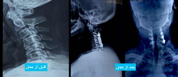 posterior-cervical