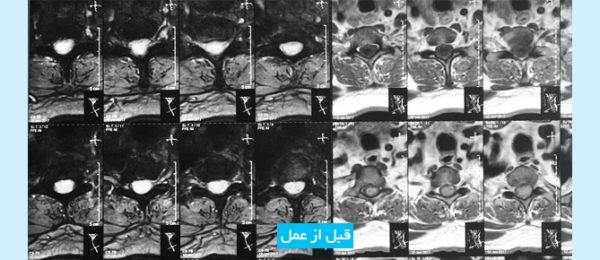 spinal-cord-tumor-FA