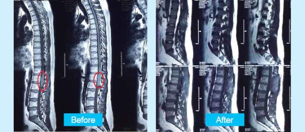 spinal-cord-tumor-en