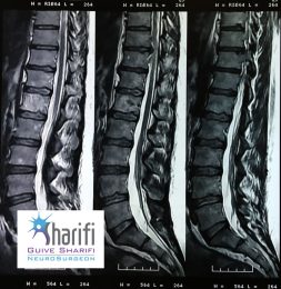 thoracic-disc-before1