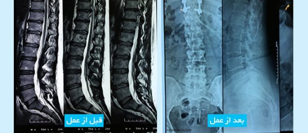 thoracic-disc-fa